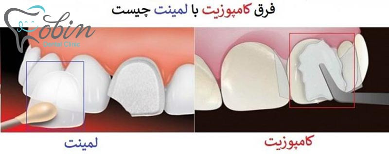 مقایسه لمینت دندان و کامپوزیت دندان